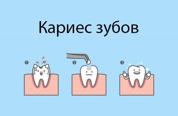 Кариес и другие болезни зубов